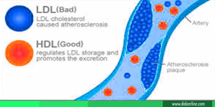 Perbedaan LDL dan HDL