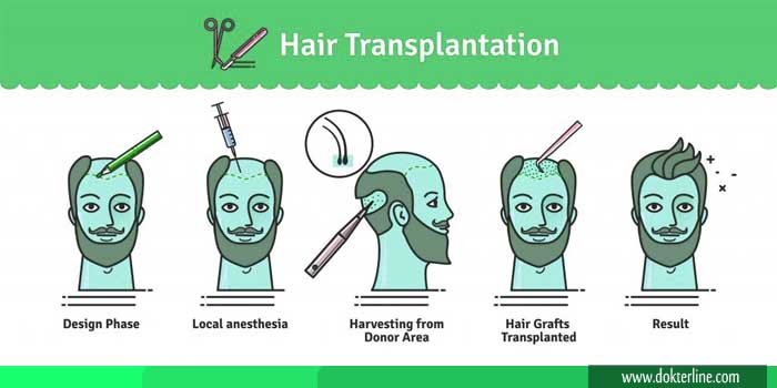 Transplantasi rambut cangkok rambut