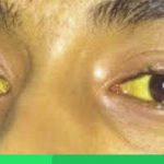 penyebab mata kuning