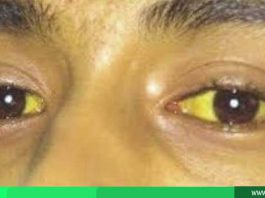 penyebab mata kuning