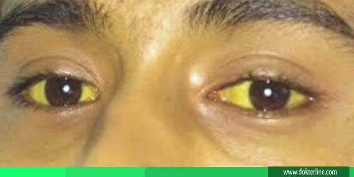 Penyebab Mata Kuning  pada anak dan dewasa DOKTERLiNE