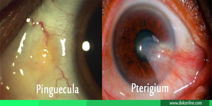 perbedaan pterigium dan pinguecula
