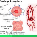 cervix incompetent cerclage suture
