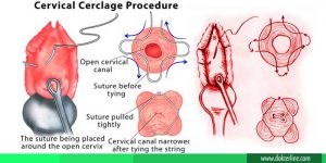 cervix incompetent cerclage suture