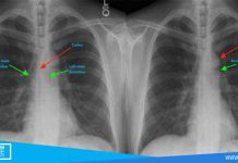 cara membaca x ray thorax