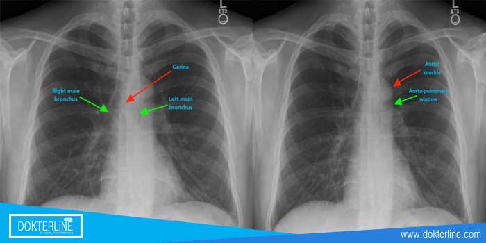 cara membaca x ray thorax