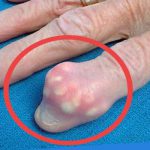 gout artritis asam urat
